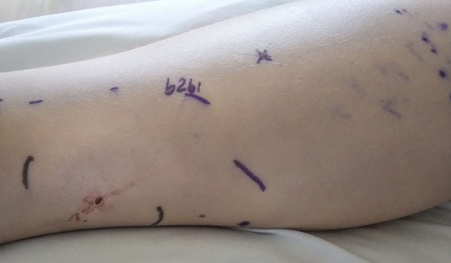 bite mark